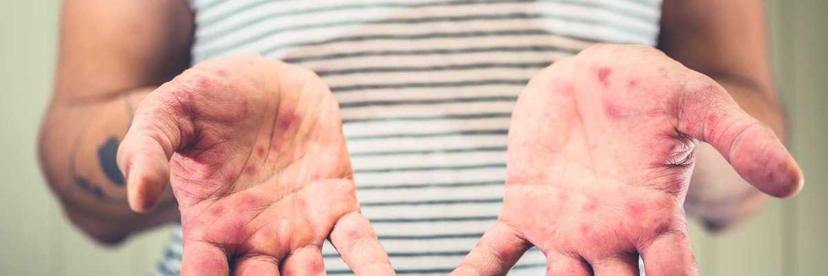 Person's hands with red spots, wearing striped shirt.