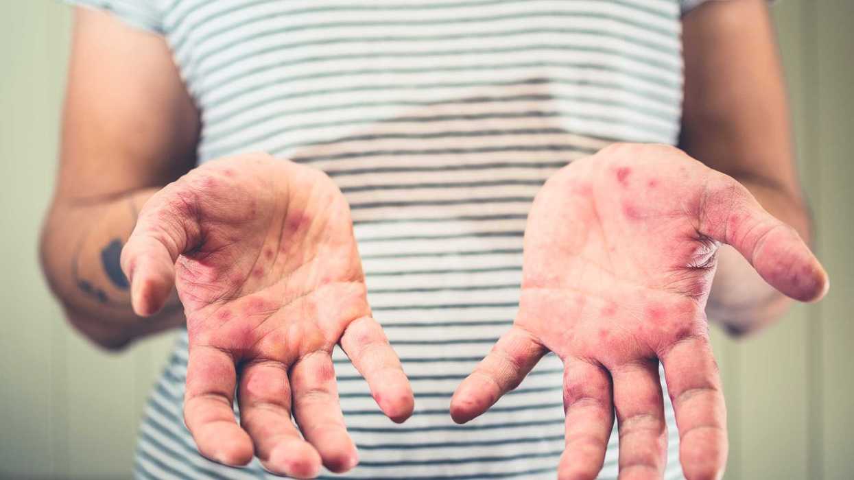 Person's hands with red spots, wearing striped shirt.